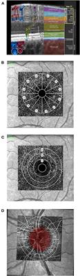 Retinal Microcirculation as a Correlate of a Systemic Capillary Impairment After Severe Acute Respiratory Syndrome Coronavirus 2 Infection